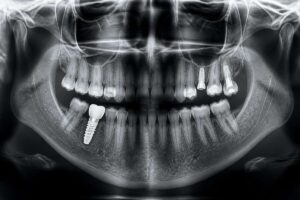 Read more about the article Oseointegracija: Saznajte sve o procesu vezivanja implantata za kost