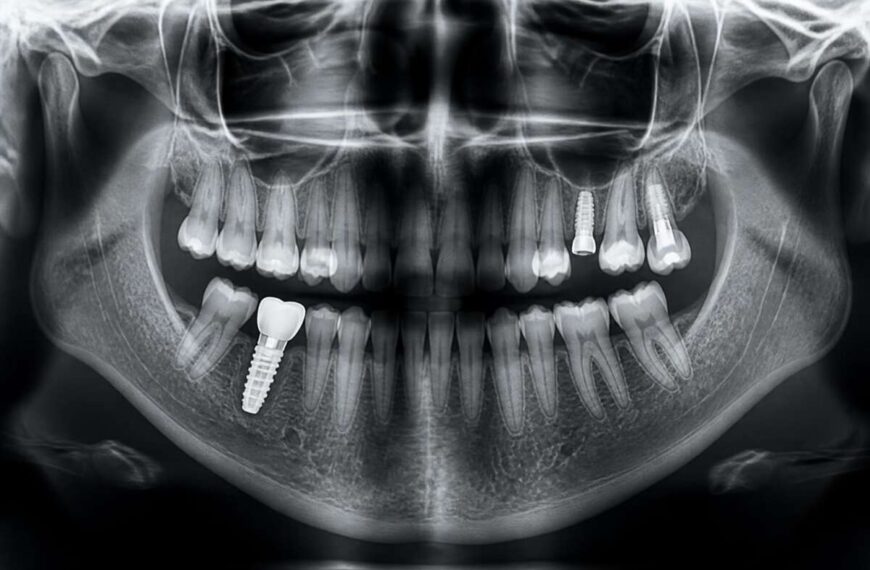 Oseointegracija: Saznajte sve o procesu vezivanja implantata za kost