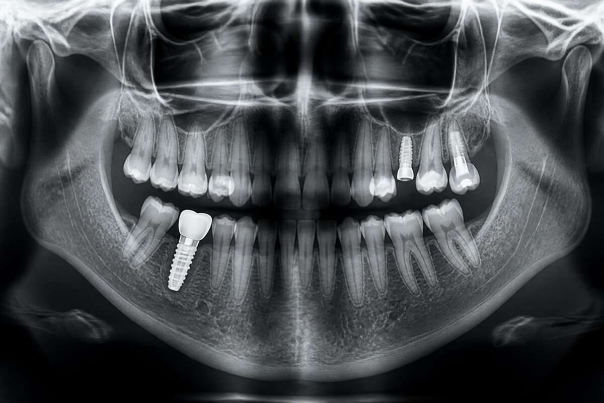 You are currently viewing Oseointegracija: Saznajte sve o procesu vezivanja implantata za kost