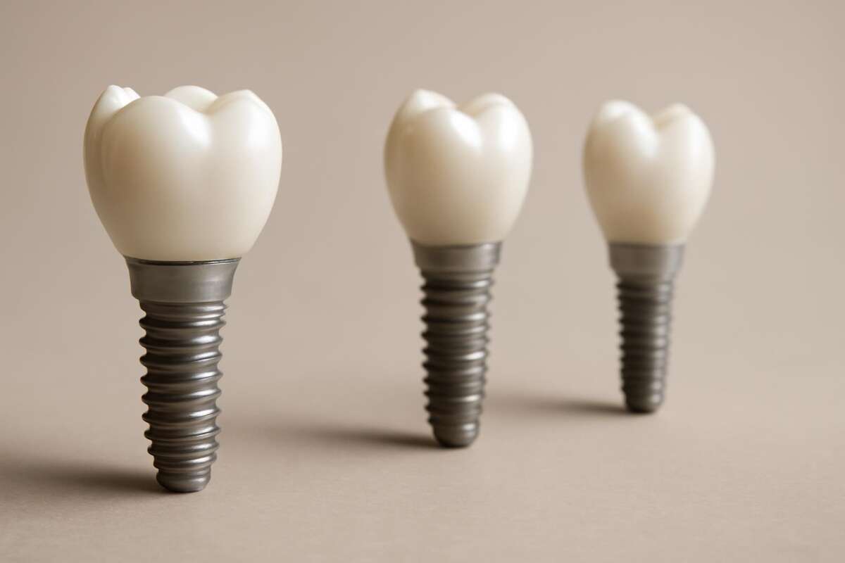 Cena zubnih implantata: Šta sve utiče na cenu implantata za zube?