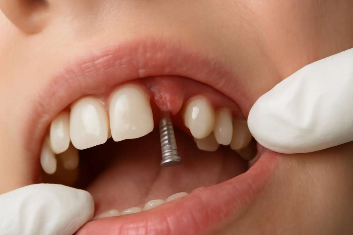 Odbacivanje zubnog implantata: Simptomi, uzroci i metode lečenja