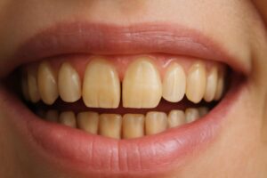 Read more about the article Erozija zuba: Uzroci, simptomi i lečenje dentalne erozije